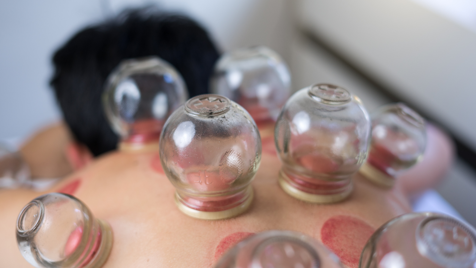 Cupping therapy in Noida